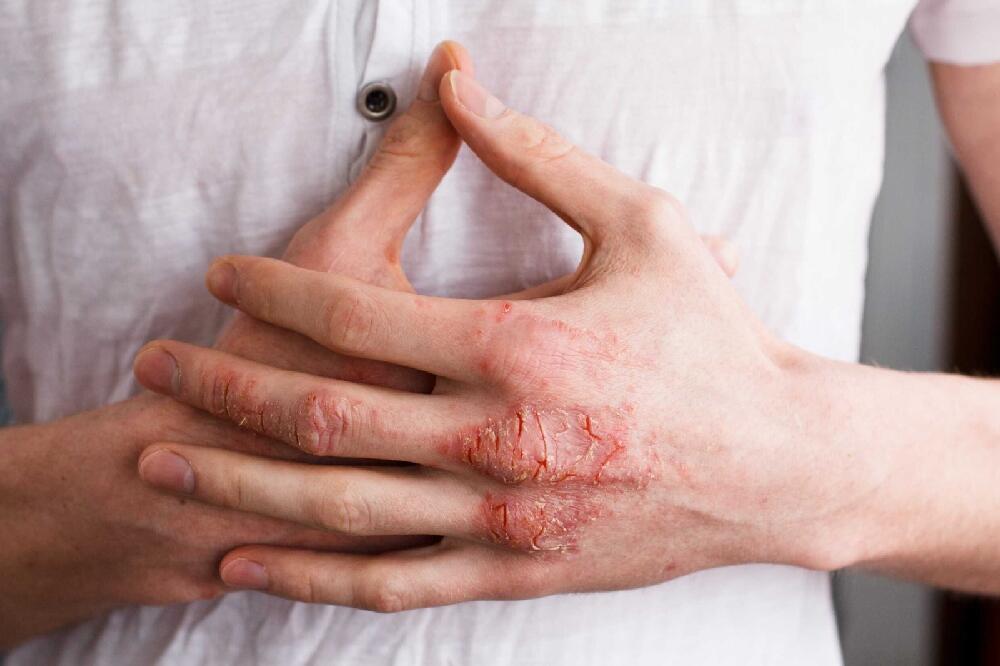 Atopowe zapalenie skóry - jak dbać o skórę z AZS? / 