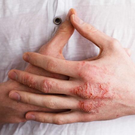 Atopowe zapalenie skóry - jak dbać o skórę z AZS? / 